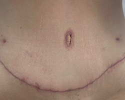 Skin Remove Surgery-4